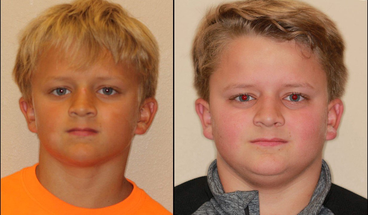 Early Orthodontic Treatment Early Orthodontic Treatment