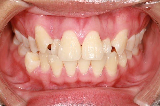 How Orthodontics Realigns the Face and Teeth How Orthodontics Realigns the Face and Teeth